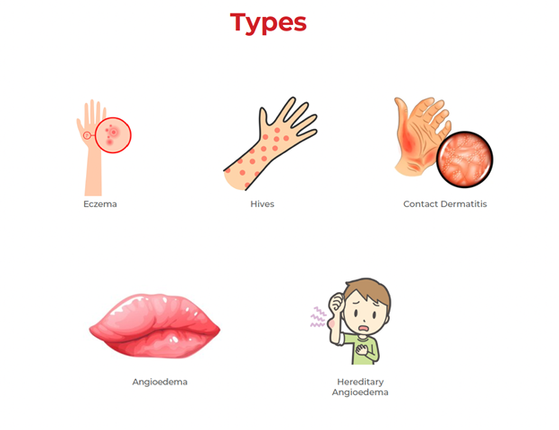 allergies, B cells, immunology